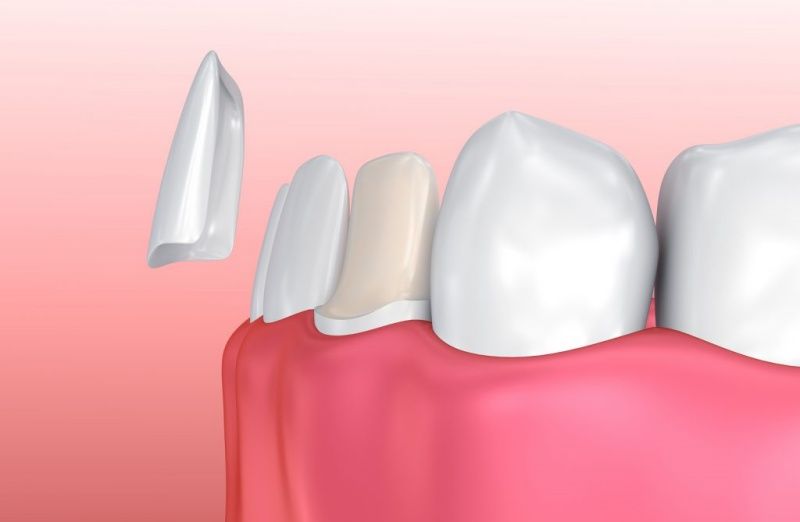 Bọc răng sứ là giải pháp cải thiện thẩm mỹ