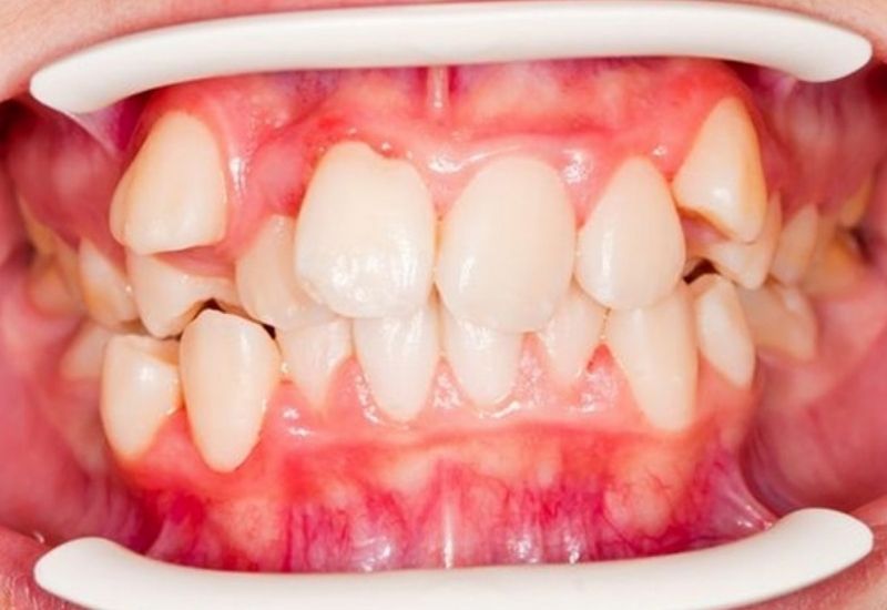 Răng bị lệch khớp cắn nghiêm trọng không nên bọc sứ