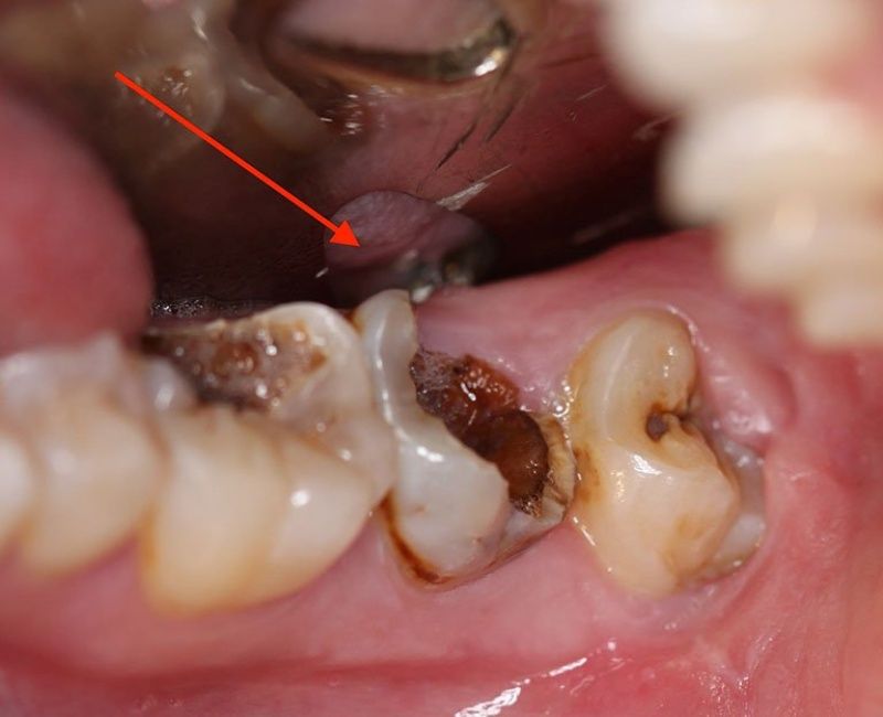 Răng bị sâu quá nặng không nên bọc sứ