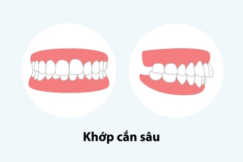 Khớp cắn sâu là tình trạng răng lệch lạc, mất cân đối