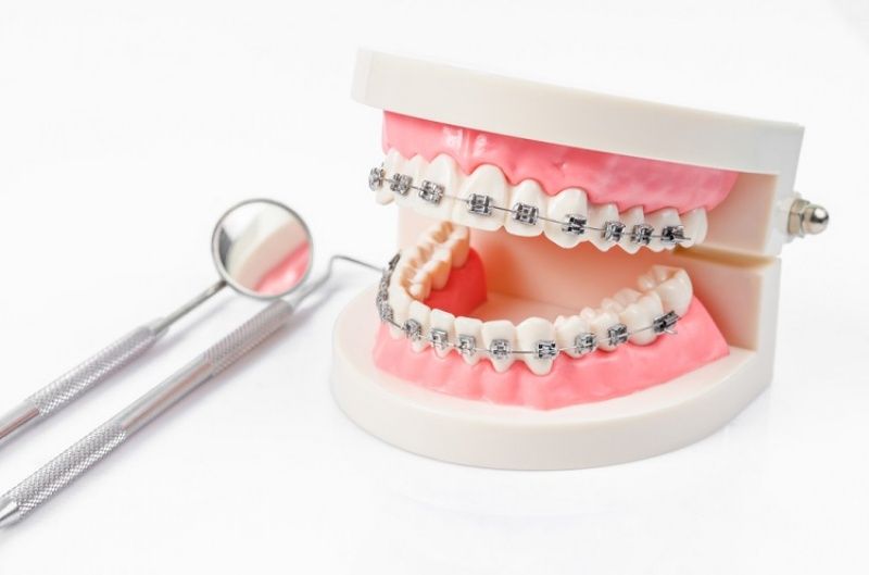 Niềng răng là giải pháp giúp khắc phục tình trạng khớp cắn sâu