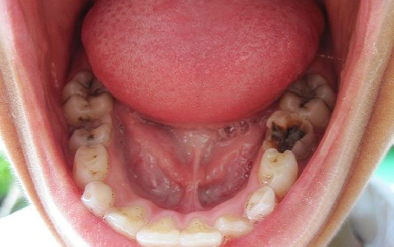 Răng cấm bị sâu lung lay ảnh hưởng đến ăn nhai