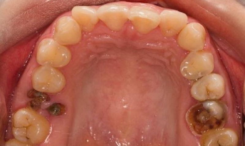 Tình trạng răng hàm bị sâu chỉ còn chân răng