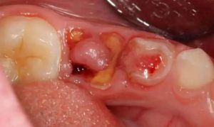 Chân răng sâu là nơi tích tụ vi khuẩn