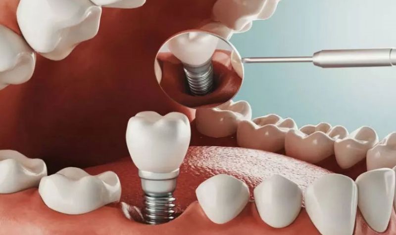 Nên phục hình bằng răng Implant sau khi nhổ chân răng sâu