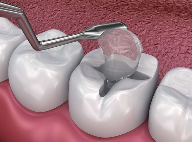 Hàn trám răng là giải pháp khi răng số 7 bị sâu vỡ nhẹ