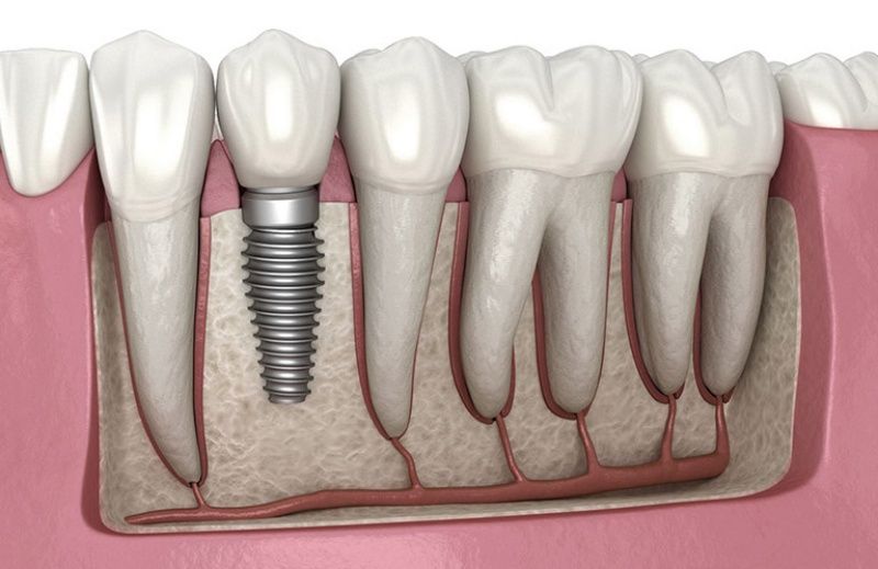 Trồng răng Implant là phương pháp phục hình răng đã mất