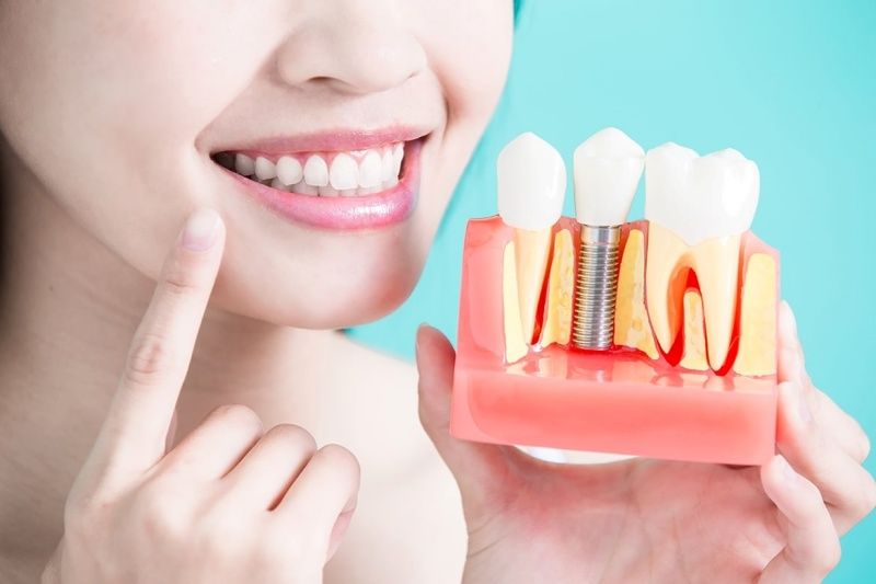 Trồng răng Implant giúp cải thiện thẩm mỹ cao