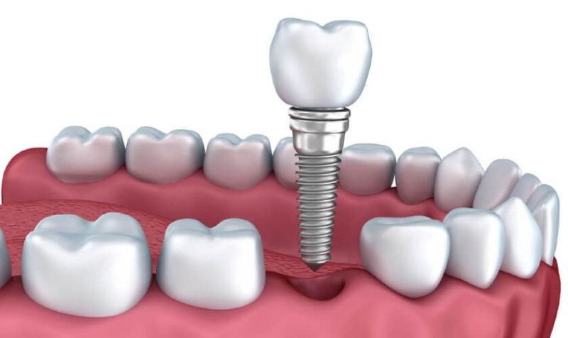 Trồng răng Implant cho người già là giải pháp tối ưu