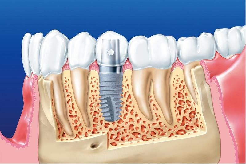 Xương hàm cần đảm bảo chắc khỏe để cấy ghép Implant