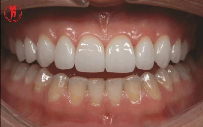 Răng sứ bị đổi màu sau một thời gian sử dụng