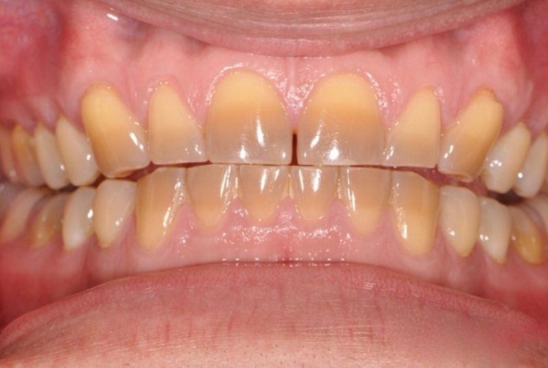 Trường hợp răng bị nhiễm màu nặng nên bọc răng sứ nguyên hàm