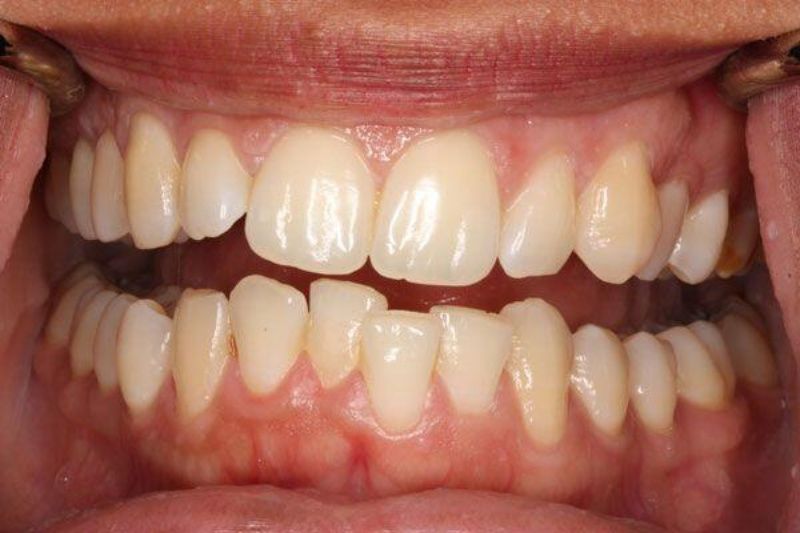 Tình trạng răng mọc lệch mức độ nhẹ