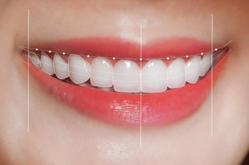 Bọc răng sứ nguyên hàm giúp tăng tính thẩm mỹ