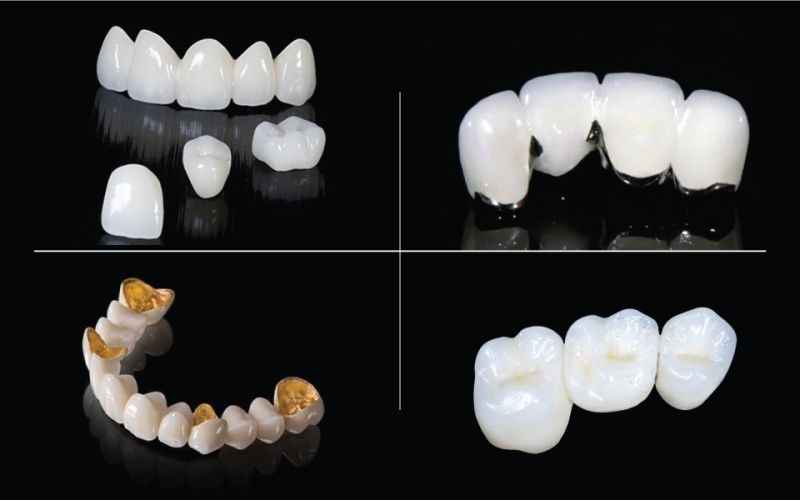Có nhiều loại răng sứ với những đặc tính và giá cả khác nhau