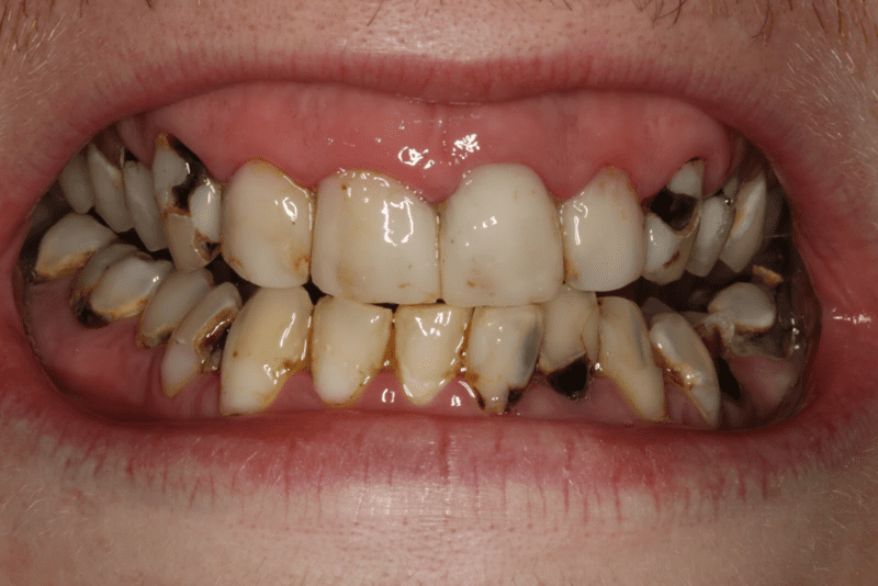 Sâu răng là vấn đề răng miệng thường gặp