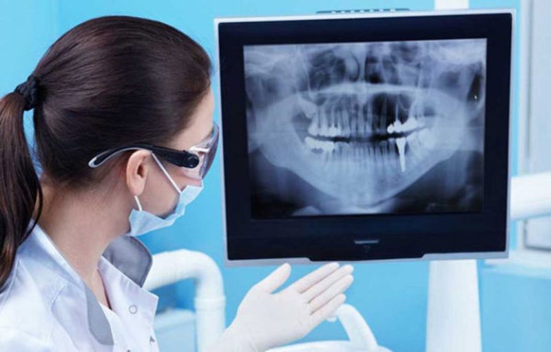 Chụp X - Quang để xác định tình trạng răng bị sâu