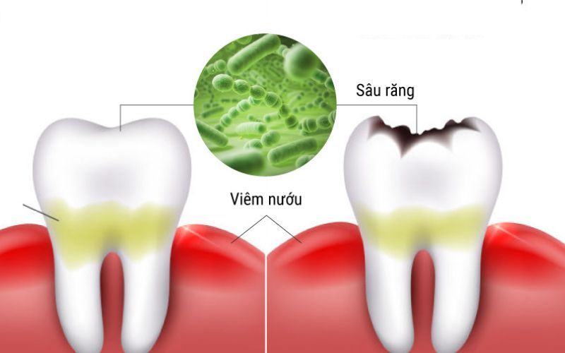 Sâu răng dẫn đến tình trạng viêm nướu