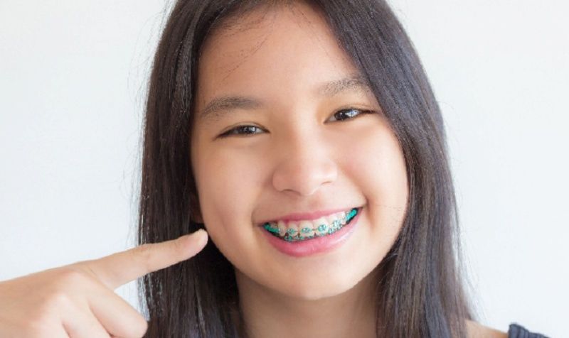 Niềng răng giúp cải thiện tình trạng răng lệch lạc hiệu quả