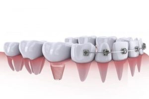 Niềng răng sau khi trồng Implant